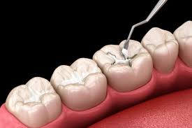 Pediatrics (Sealants)